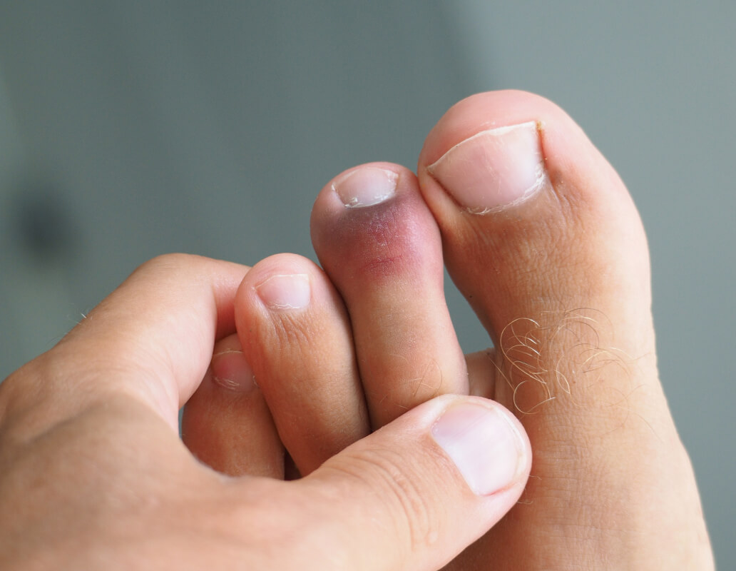 Checking feet for fungus