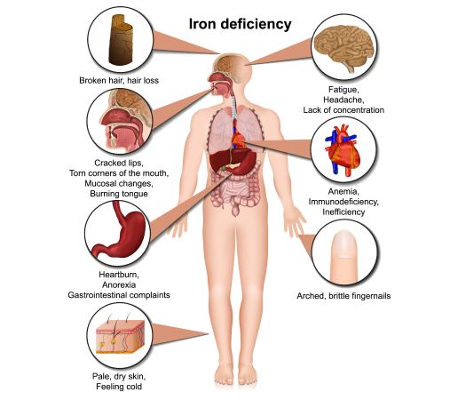 Iron deficiency